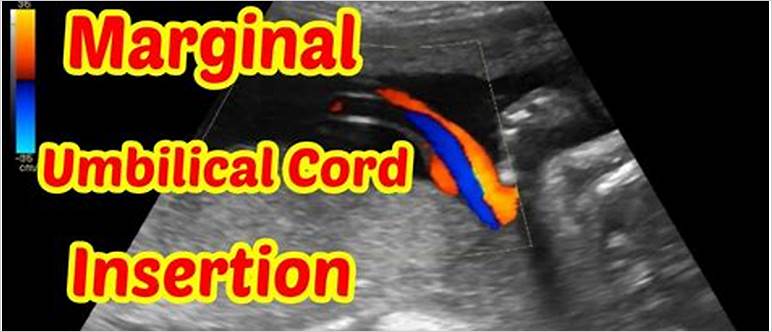 Umbilical cord insertion marginal